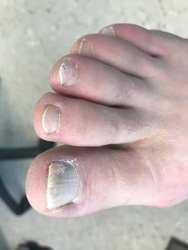 fenstrated nail