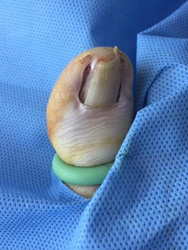 toenail during