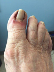 toenail postop