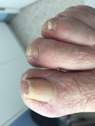 toenail preop