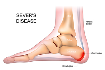 Sever s Disease and Heel Pain