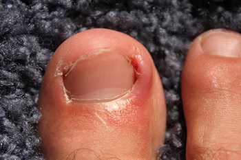 ingrown toenail