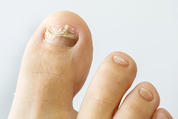 toenail fungus