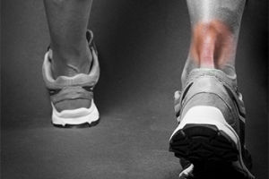 All About Achilles Tendonitis