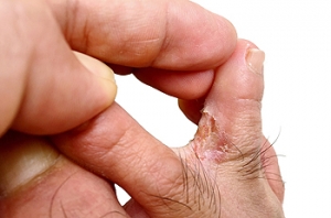 Symptoms and Causes of Athlete’s Foot
