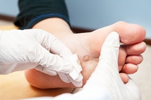 Treatment for Plantar Warts