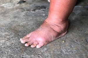 Swelling of the Feet in the Summertime