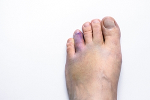 Causes and Symptoms of a Broken Toe