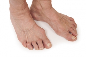 How Rheumatoid Arthritis Can Affect the Feet