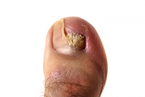 Common Causes of Toenail Pain