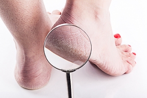 Reasons Cracked Heels Can Develop