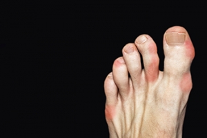 How Gout Attacks May Be Reduced