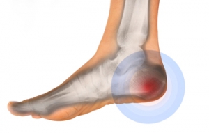 Exercises to Alleviate Heel Pain