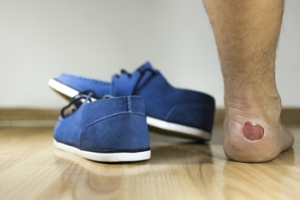 How Did I Get a Blister on My Foot?